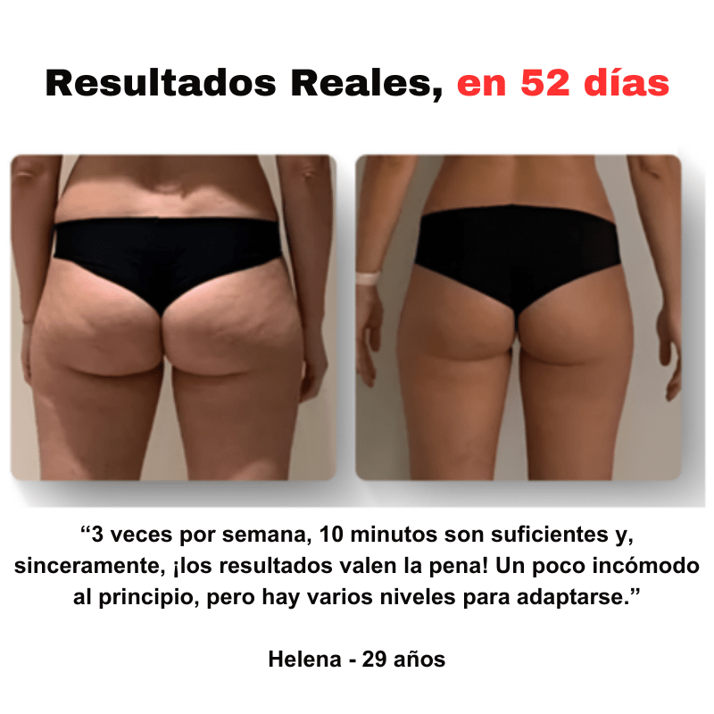 ¡Última oportunidad! Esta oferta expira en 2 horas - SmoothGlow™ - Masajeador anticelulítico